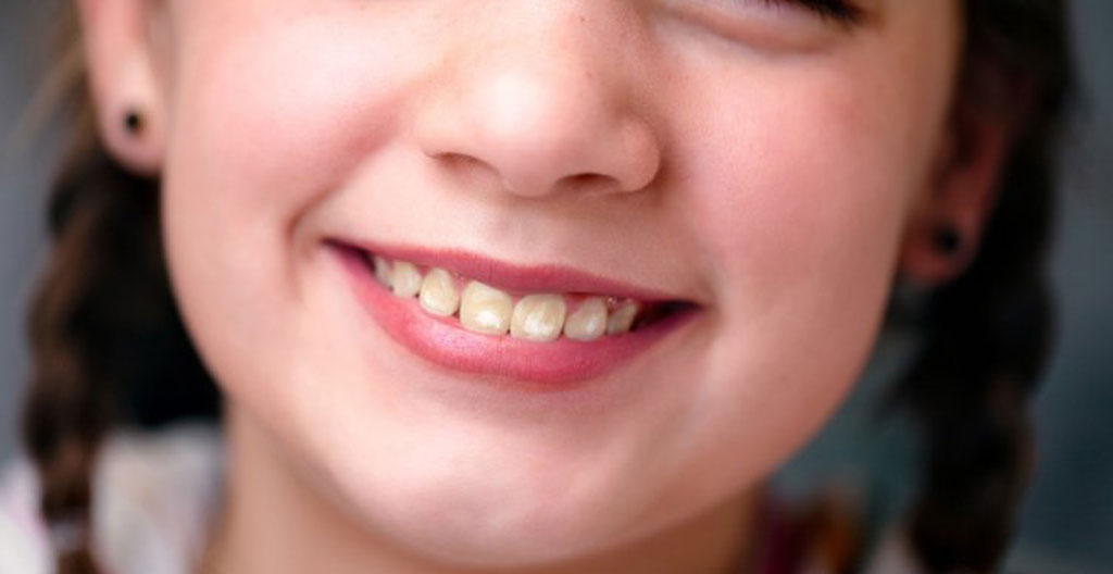 Comparaison macro de deux dents : une saine et une avec fluorose légère présentant de fines stries blanches